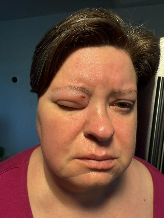 A person with significant facial swelling and bruised eye that is completely closed, along with other visible swelling on their face due to shingles.​ They are wearing a magenta colored top.